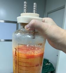 中卫水动力吸脂手术要做多久？